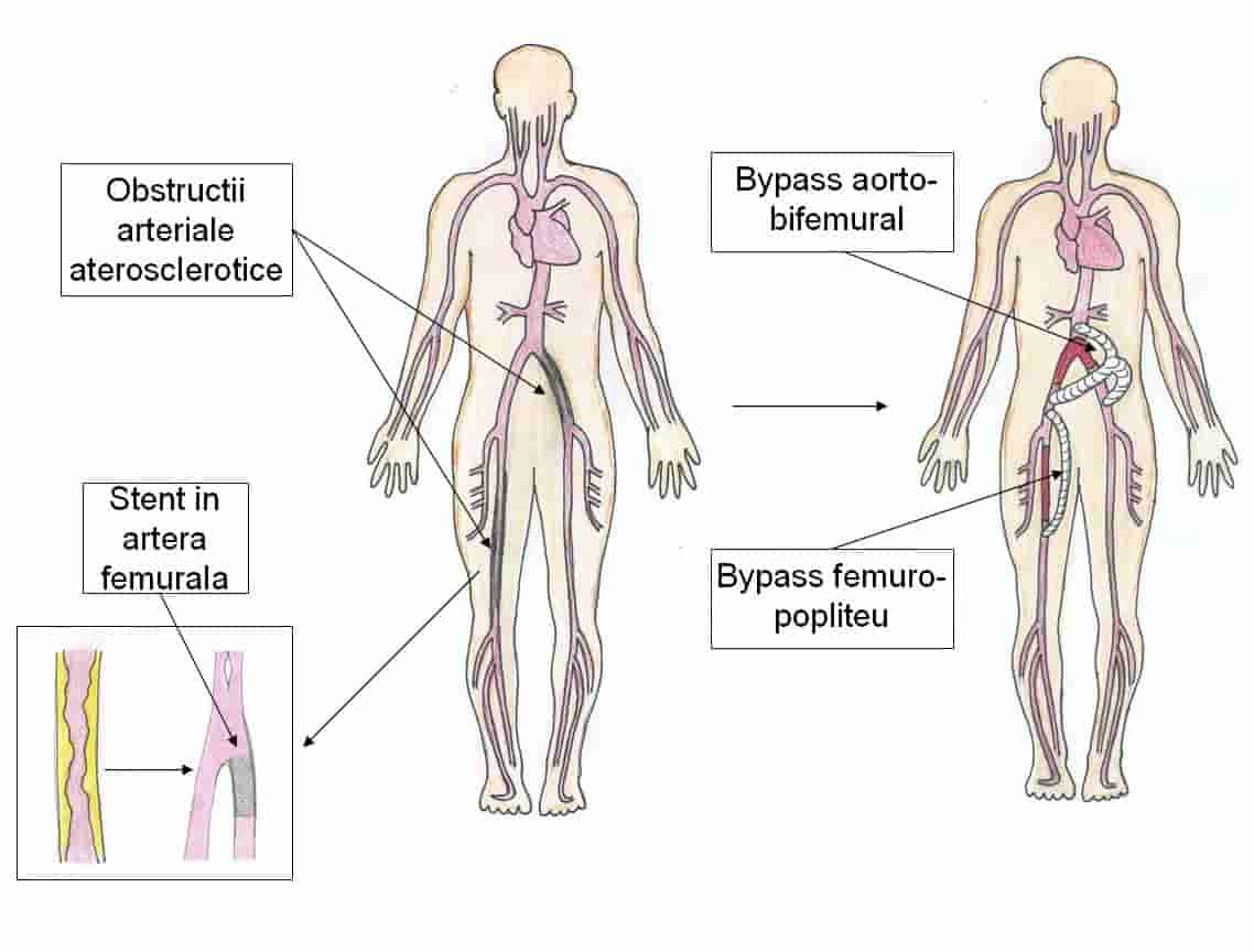 operatia de bypass si stentare