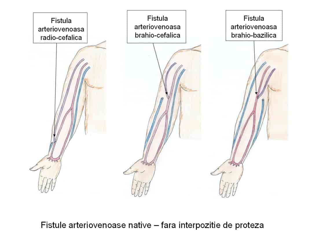 fistula arteriovenoasa pentru hemodializa