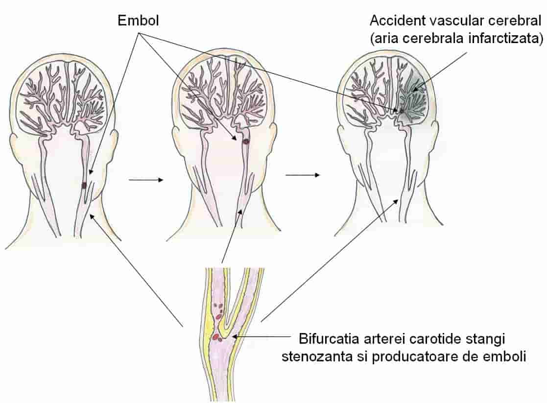 AVC si boala carotidiana