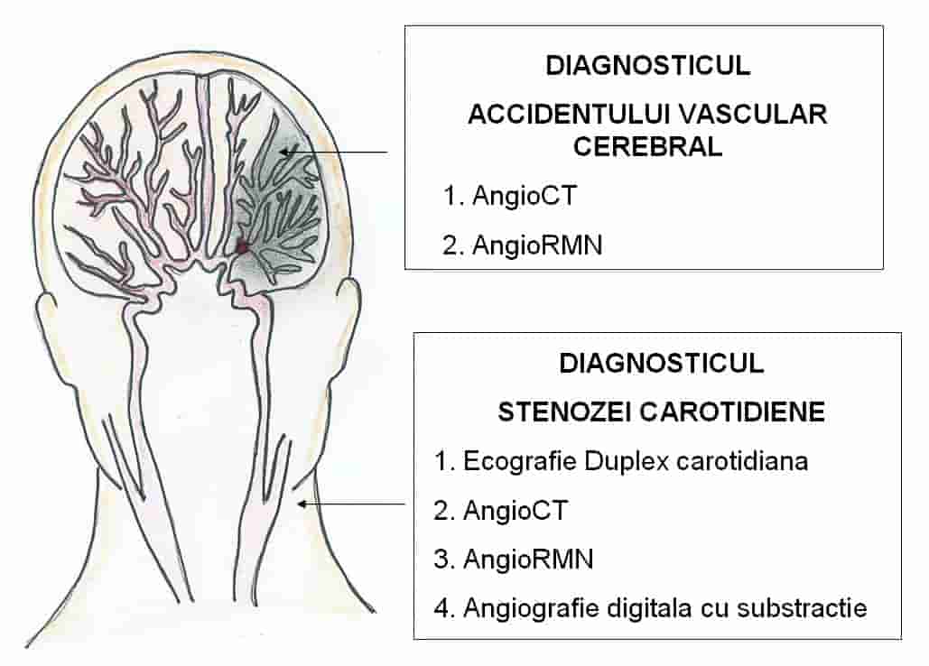 diagnostic avc si diagnostic stenoza carotidiana