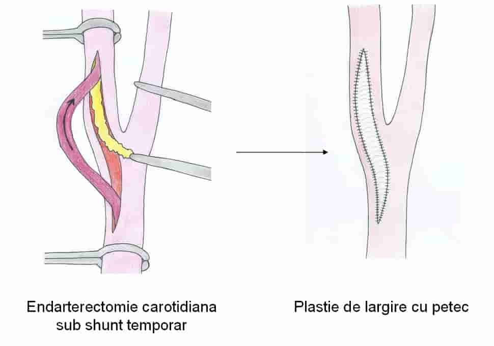 operatia de endarterectomie carotidiana