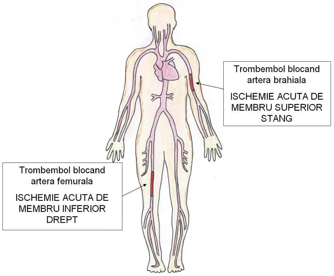 ischemie acuta