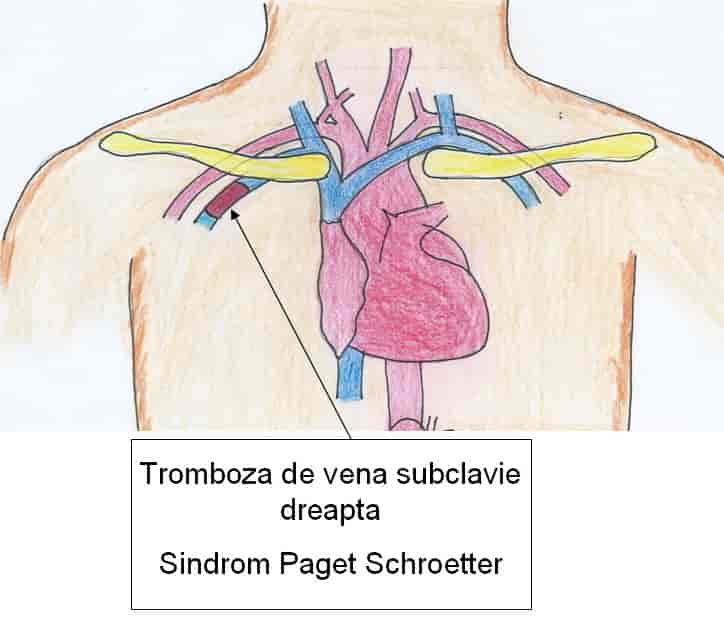 anevrism de aorta abdominala